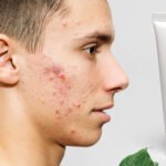 DCP TRIO ACNE SOIN SKI - 30 ML – Image 2